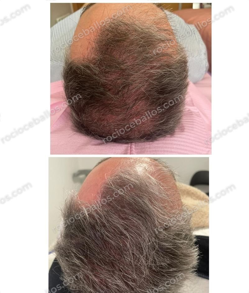 Cuero cabelludo antes y después de mesoterapia capilar