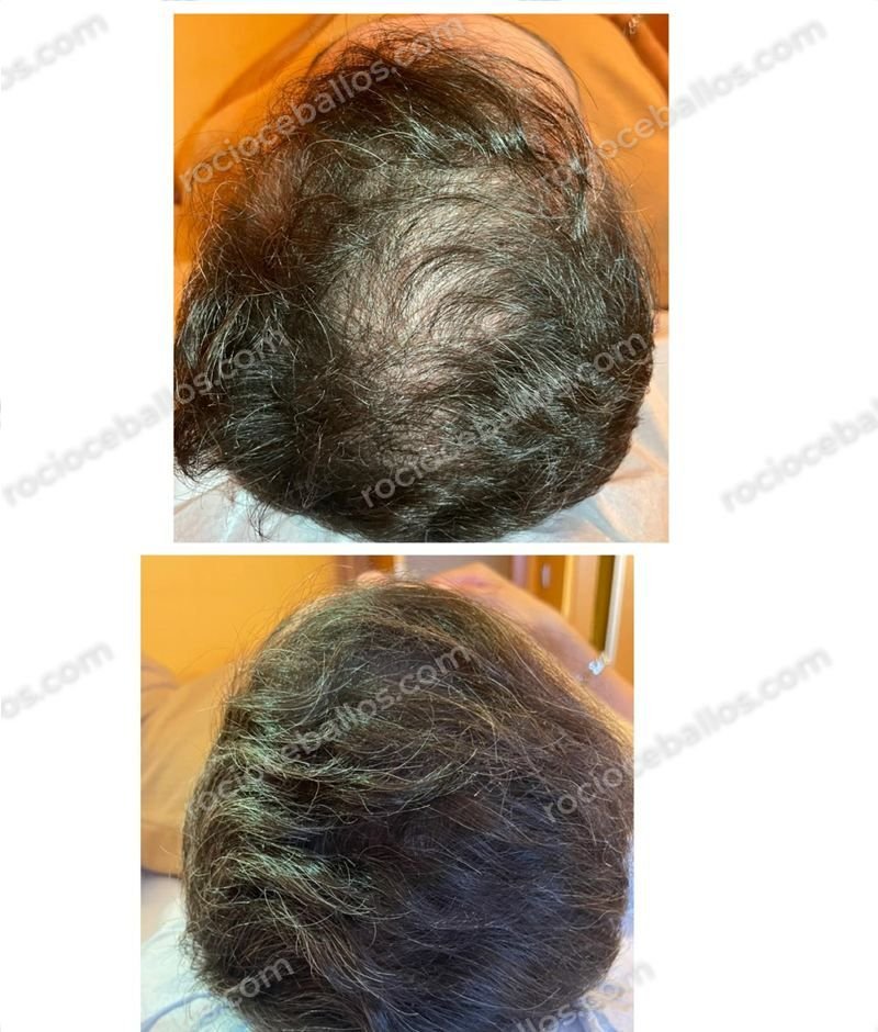 Cuero cabelludo antes y después de mesoterapia capilar