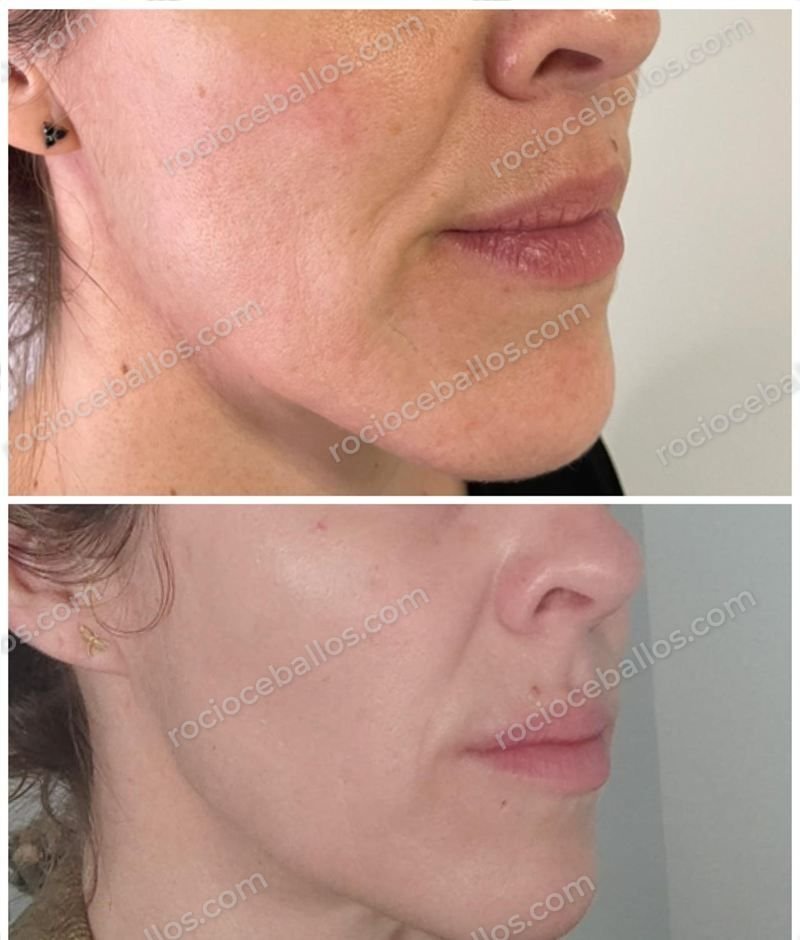 Contorno facial antes y después del tratamiento