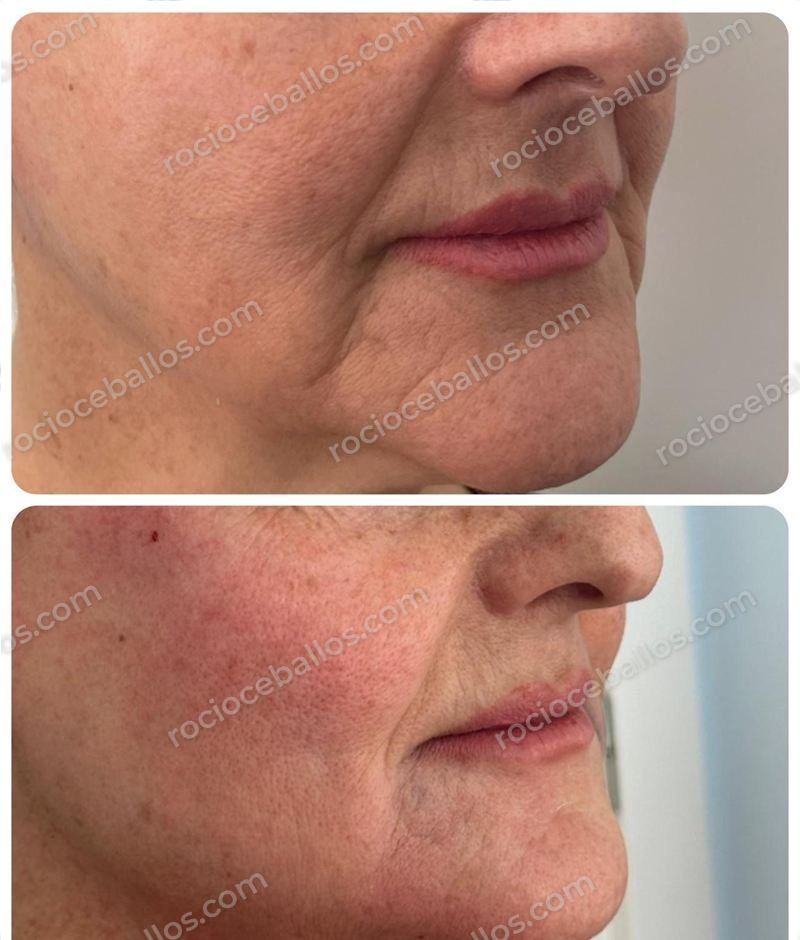 Contorno facial antes y después del tratamiento