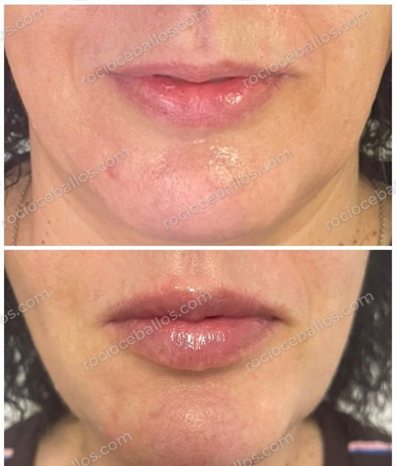 Labios antes y después de relleno con ácido hialurónico