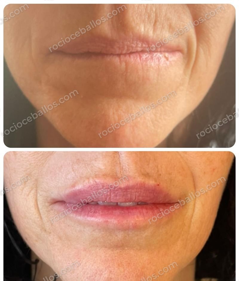 Labios antes y después de relleno con ácido hialurónico