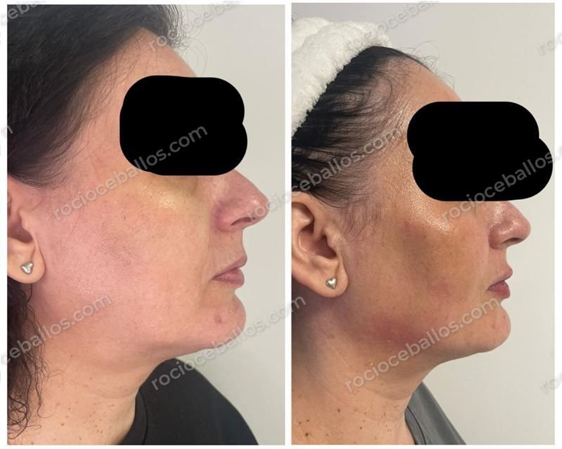 Perfil facial antes y después del tratamiento